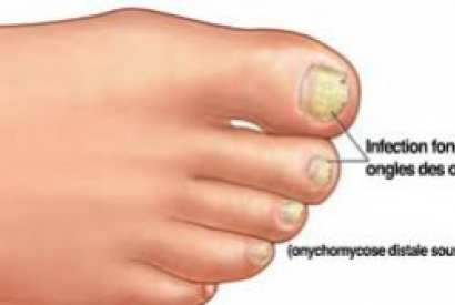 Comment traiter la mycose des ongles de pied naturellement ?